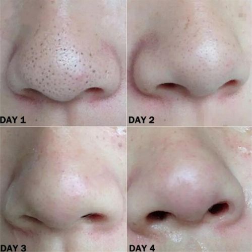 25 bandes anti-points noirs pour le nez.